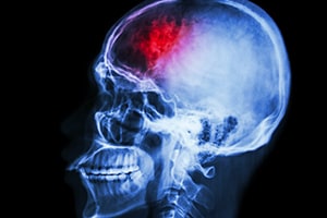 Brain Injury